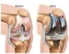 Joint Replacement Surgery