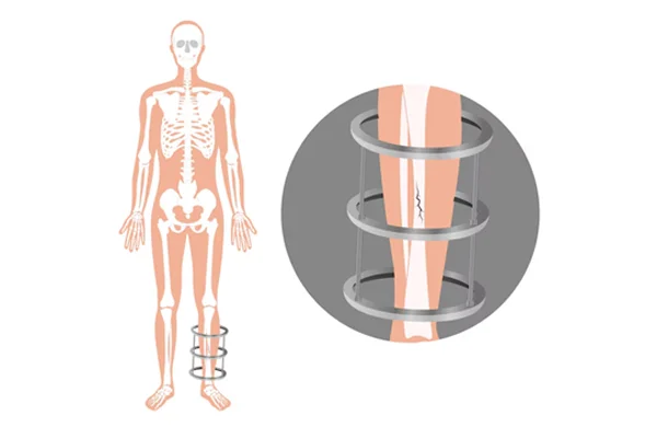 Transverse Limb Using Ilizarov Technique
